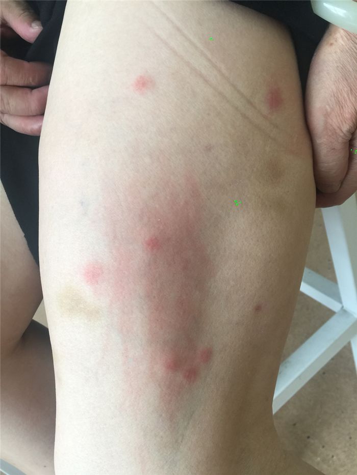 丘疹性荨麻疹也叫虫咬皮炎,主要昆虫叮咬有关,如蚊子,臭虫,蚤,虱,螨虫