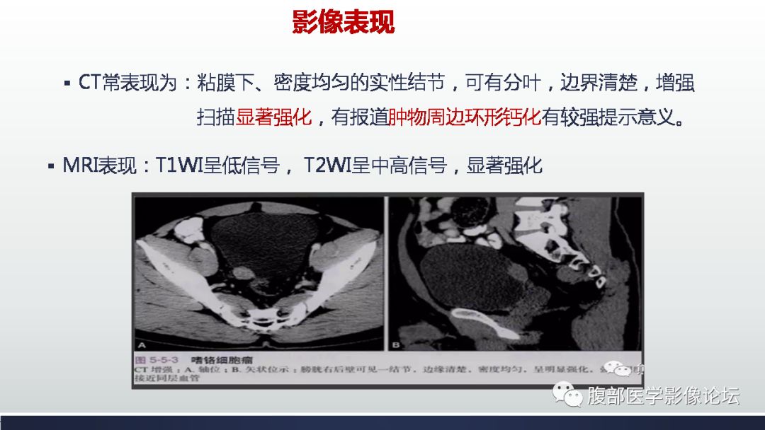 多表现为鹅卵石样凸起,乳头状或息肉样肿物§影像表现:膀胱壁局限性