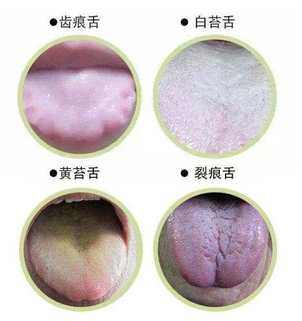 舌苔根部代表肾与膀胱,如果根部厚腻说明下焦湿热;舌苔两边代表肝胆