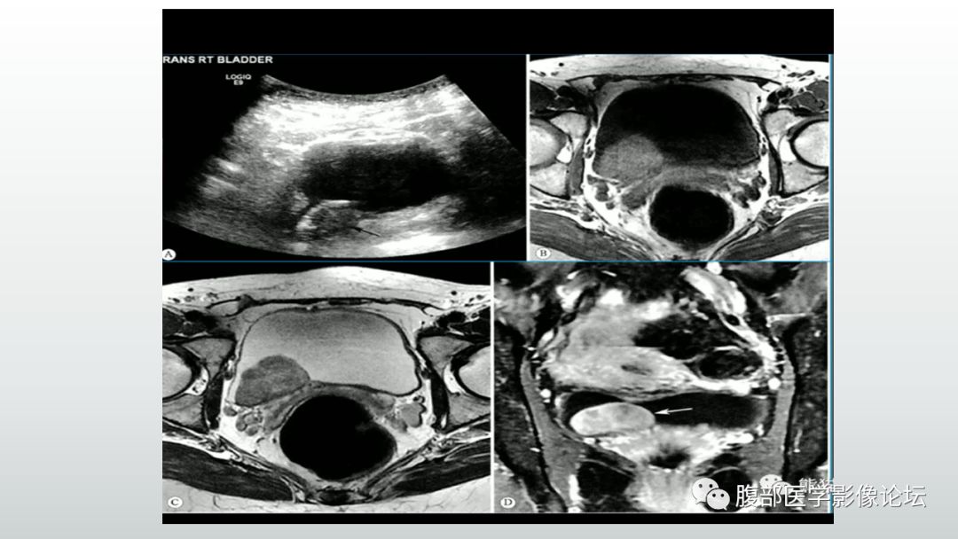 膀胱肿瘤影像表现小结