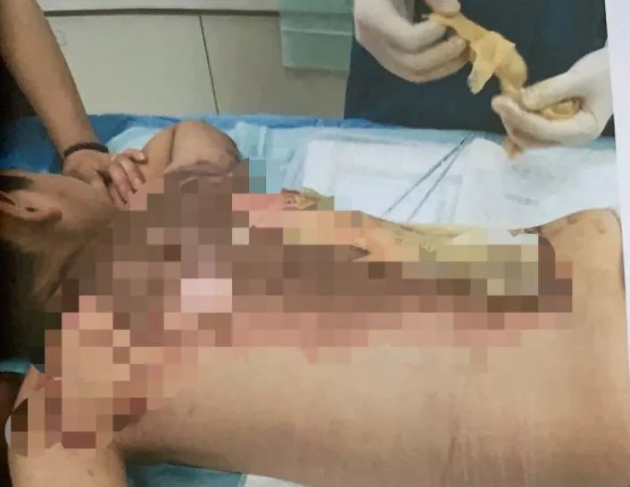                     太冲动！3岁儿子被烫伤，这名妈妈一盆开水泼向邻家孩子…