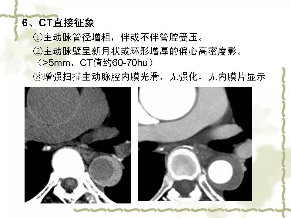 主动脉壁内血肿演变及CT表现 | 影像天地