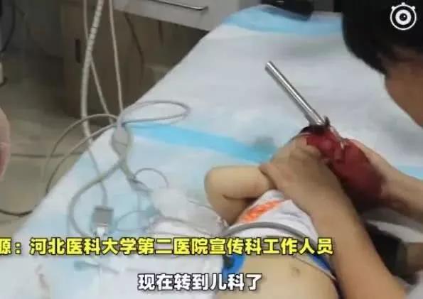                     爸妈吵架一扔晒衣杆，1米钢管直插婴儿脑袋，医生紧握小手超心疼