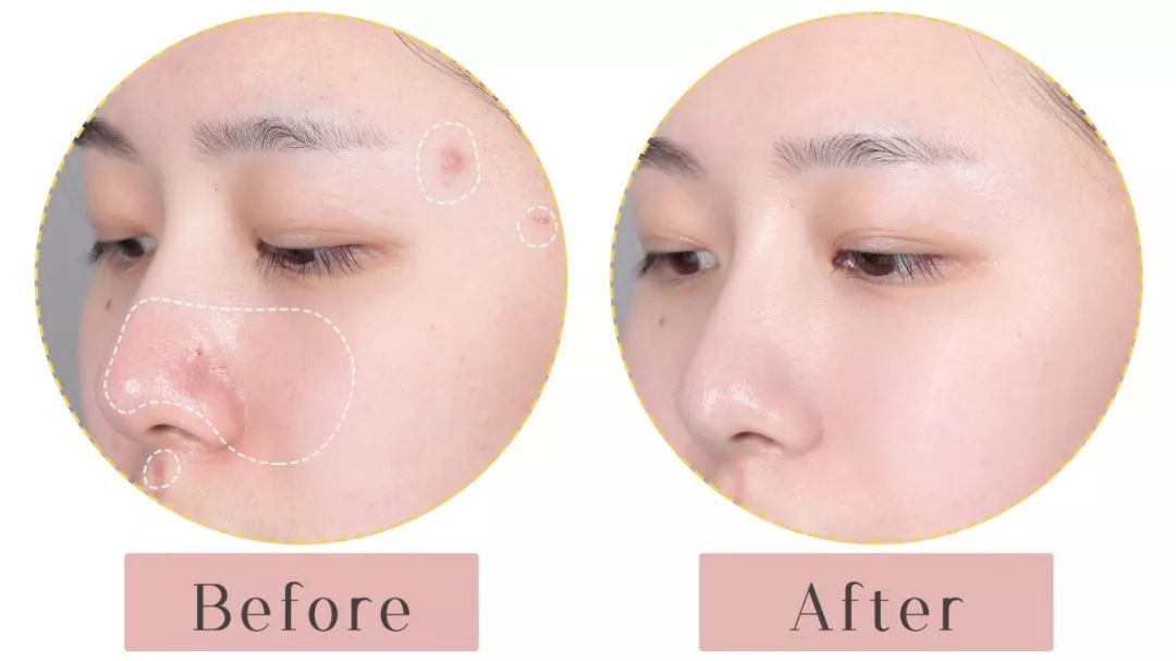 痘痘敏感肌用什么补水 4a9883b741cb4207a6328488ae7634e2.jpeg