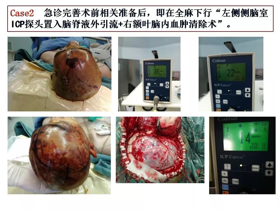 颅底探查和重建在急性颅脑损伤开颅术中的意义 | 颅脑