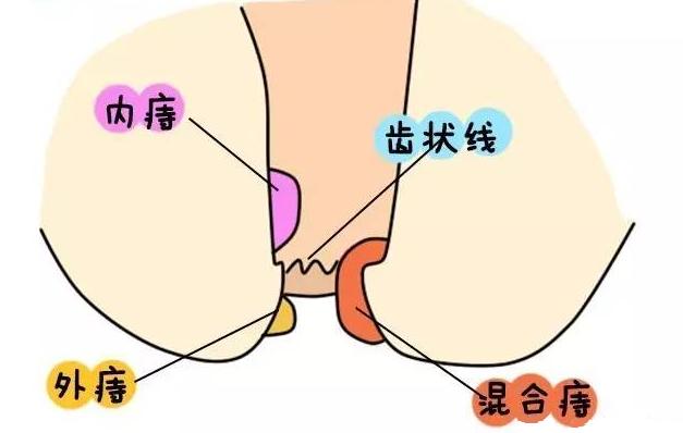 只知道垃圾分类,不知道痔疮分类,郑州丰益专家