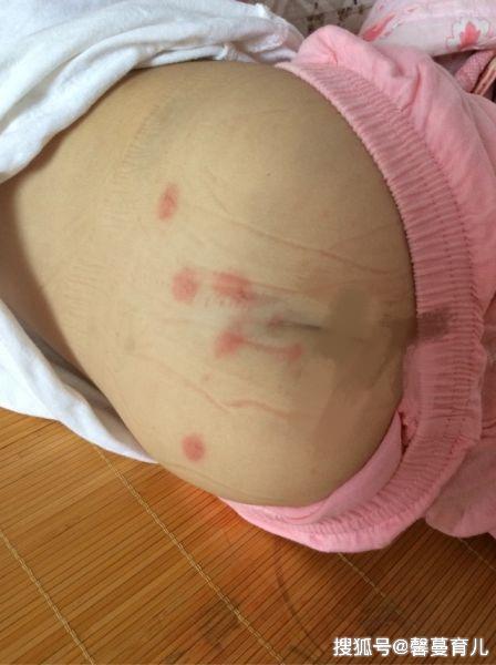                     原创            5岁女儿总说屁屁痒，老是用手挠，脱衣检查后，宝妈腿都吓软了
