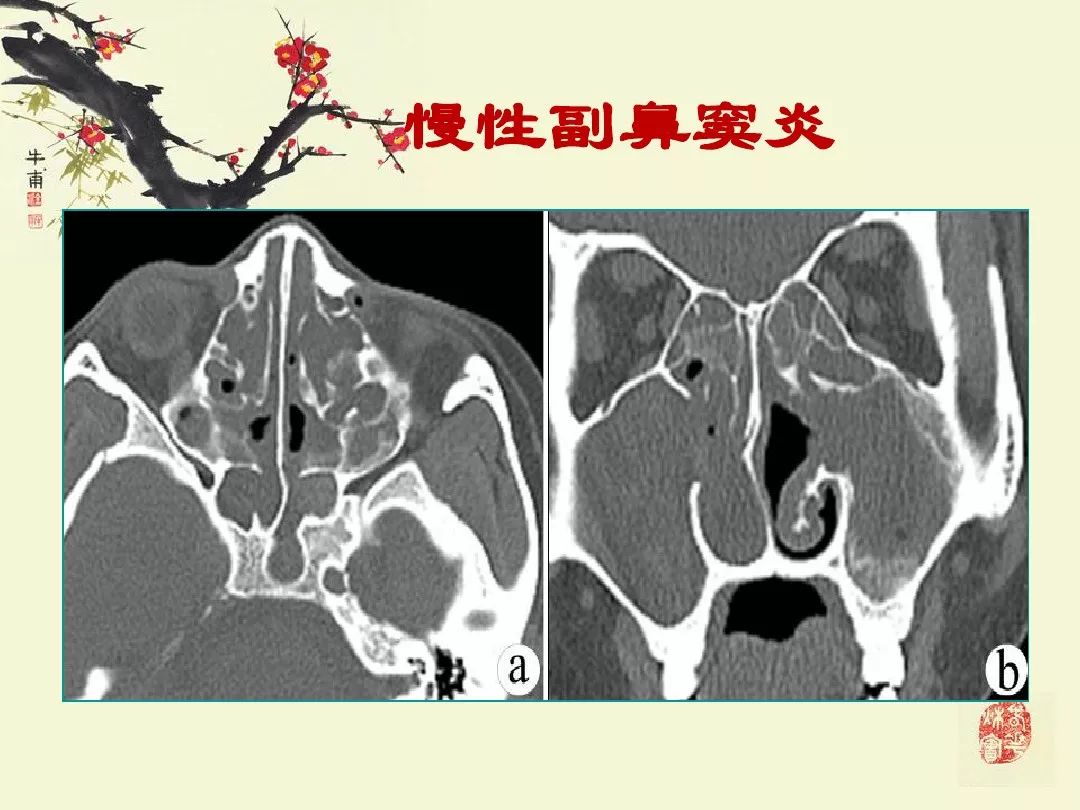 鼻,鼻窦炎的影像学表现