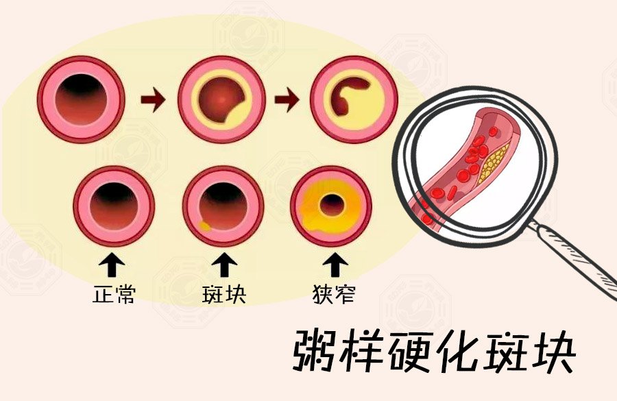 老人要经常头晕胸痛,你一定要重视!_斑块