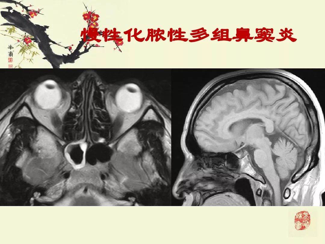 鼻,鼻窦炎的影像学表现