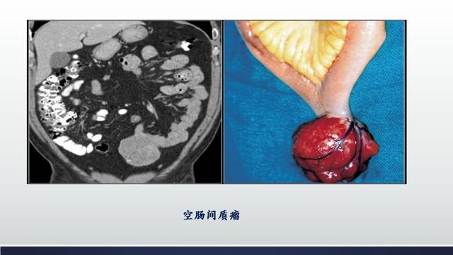 恶性者,肿瘤多大于6cm,境界欠清晰,与邻近组织