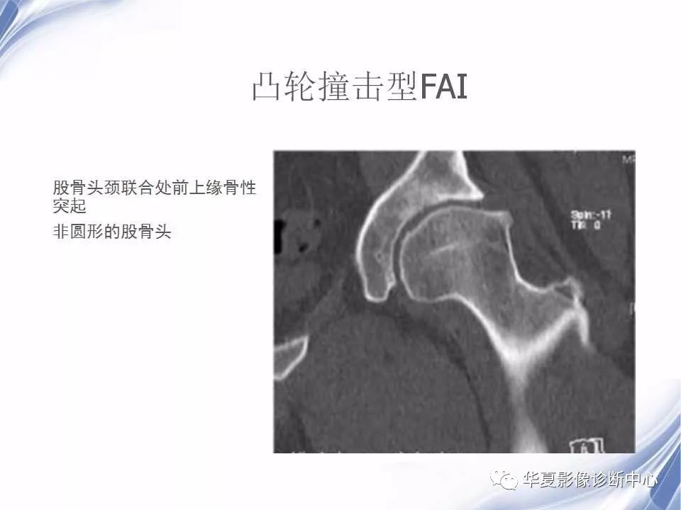 示意图钳样撞击征是股骨头颈连接处与髋臼缘反复撞击导致关节唇退变