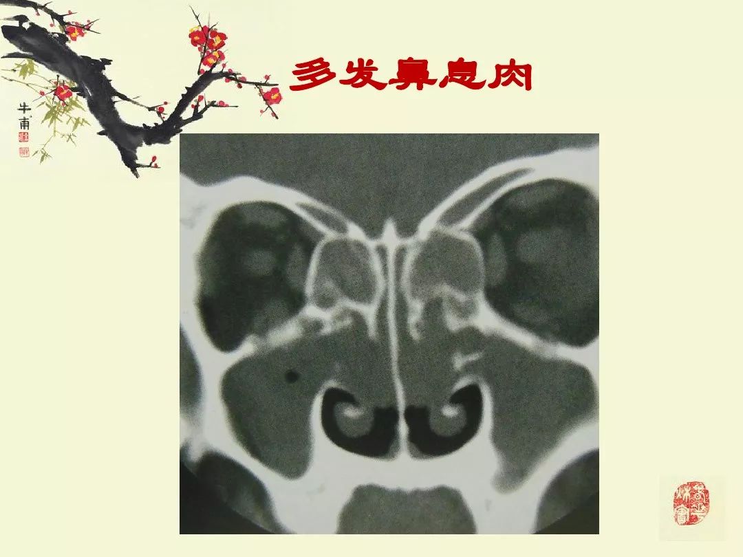 鼻鼻窦炎的影像学表现