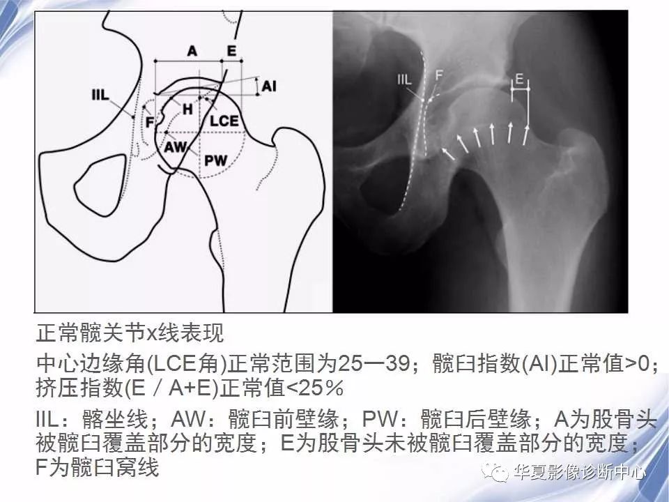 【影像基础】髋关节撞击综合征的发生机制和影