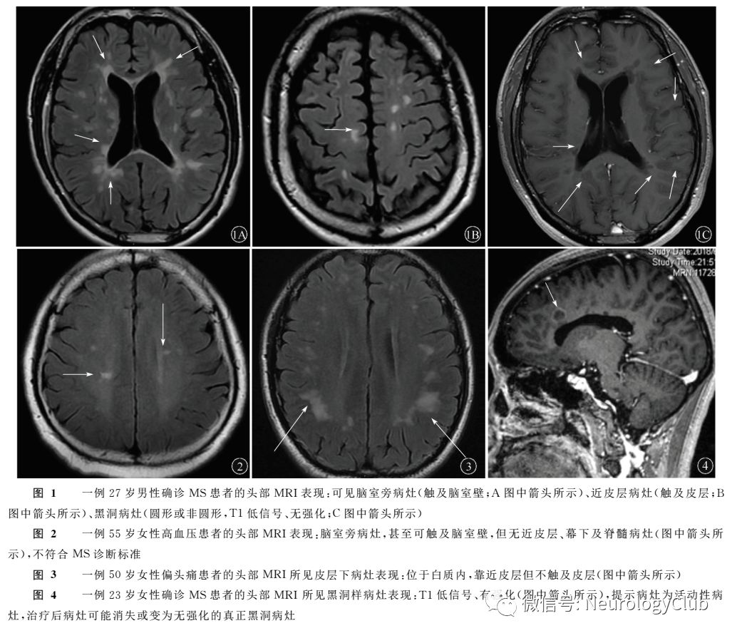 真正的可用于ms患者随访和临床试验评估的黑洞,指无强化的t1低信号灶.