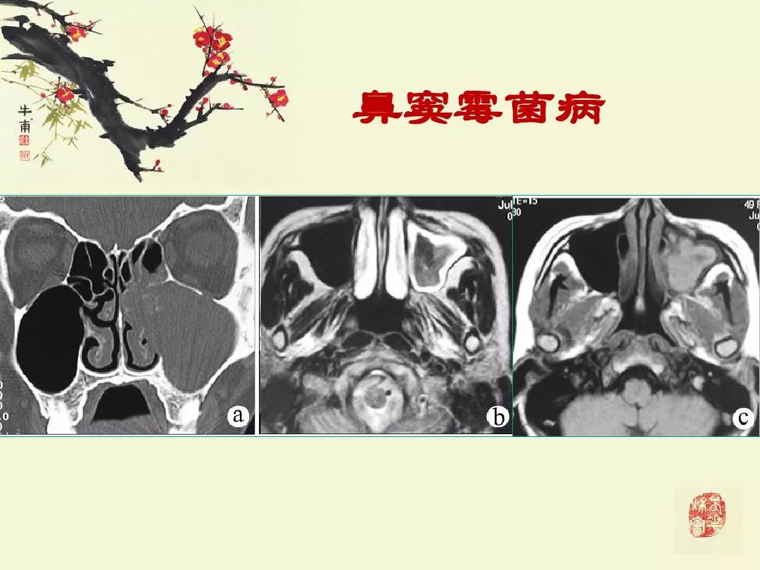 鼻,鼻窦炎的影像学表现