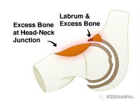 【影像基础】髋关节撞击综合征的发生机制和影像特点