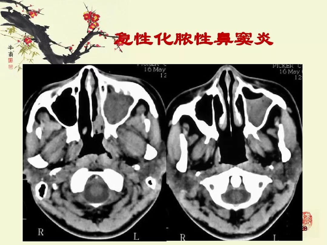 鼻,鼻窦炎的影像学表现