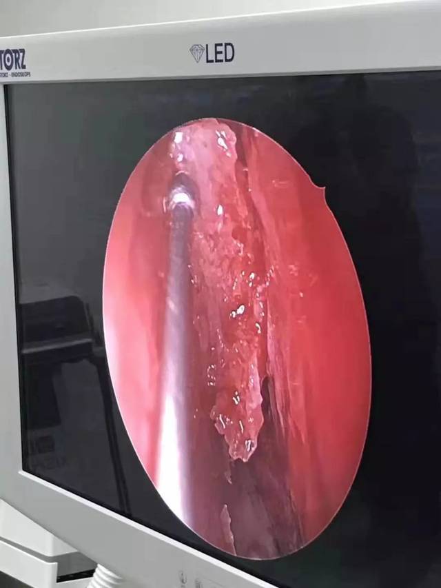 暖心！“女娲补天” 树兰医疗晋江市医院为一例自发性脑脊液鼻漏患者解除病根