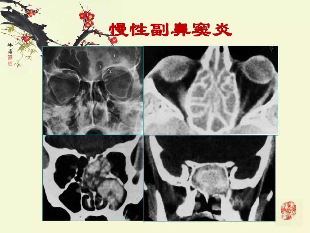 鼻,鼻窦炎的影像学表现