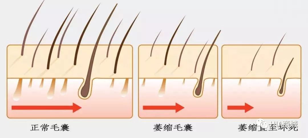 掉发严重怎么办,趁着毛囊还有救!_头发