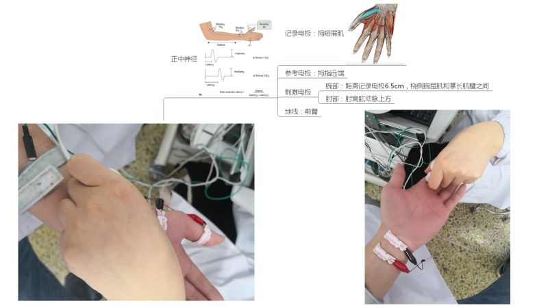 肌电图评估jebsen手功能测试purdue钉测试arat上肢动作测试wolf运动