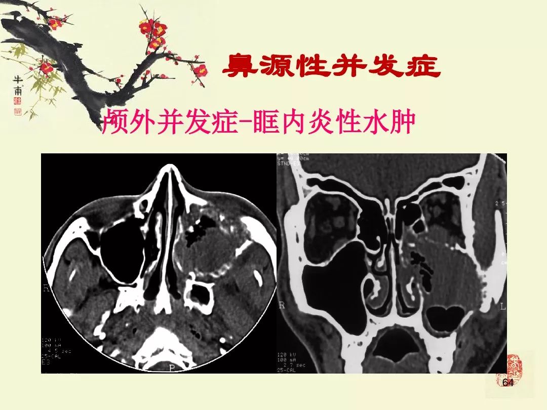 鼻,鼻窦炎的影像学表现