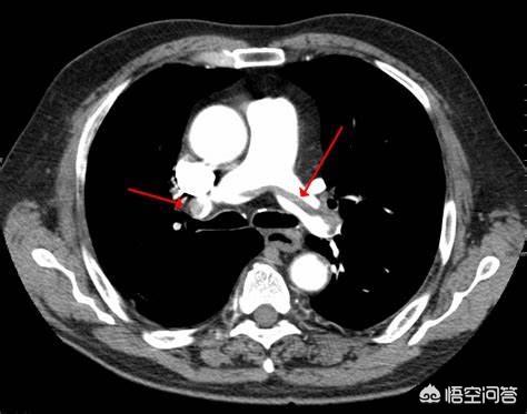 肺动脉人口图片_肺动脉高压图片