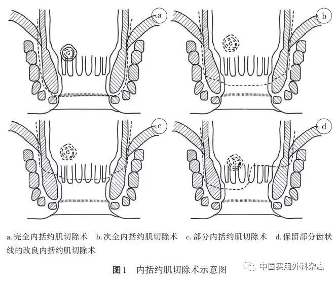 即在齿状线与内括约肌间沟之间的位置垂直于肛管长轴环形切开内括约肌