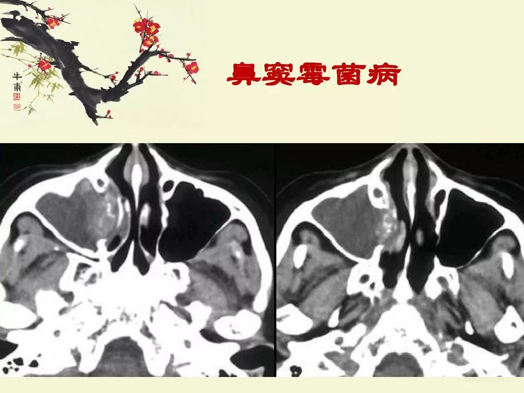 鼻,鼻窦炎的影像学表现