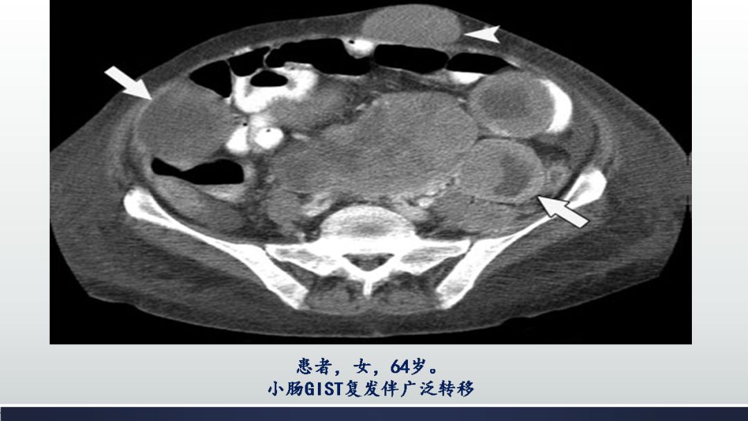 恶性者,肿瘤多大于6cm,境界欠清晰,与邻近组织