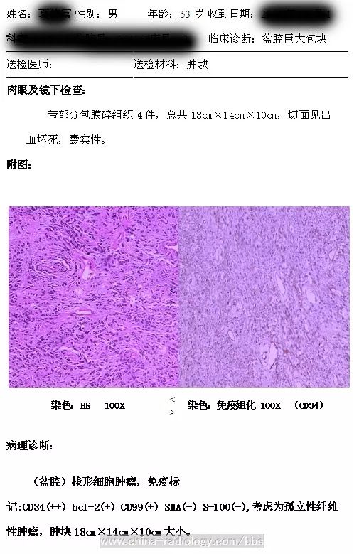 男,53岁,发现腹部肿块入院.