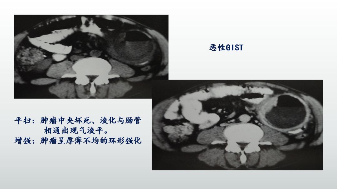 胃肠间质瘤