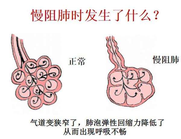 慢阻肺是绝症吗?和肺癌有什么关系?