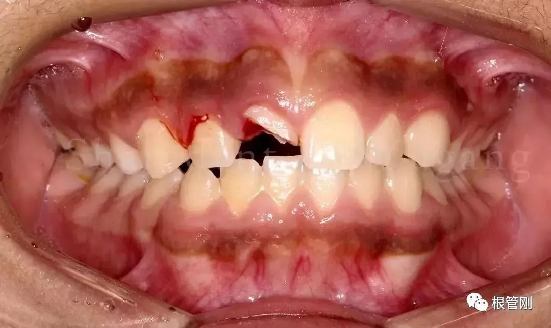 复杂牙外伤的断牙再接活髓保存一例