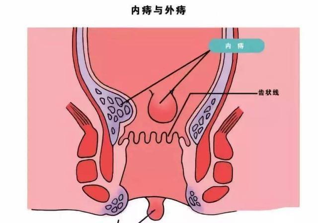 内痔出血怎么办?这些方法让你彻底远离痔疮_肛门