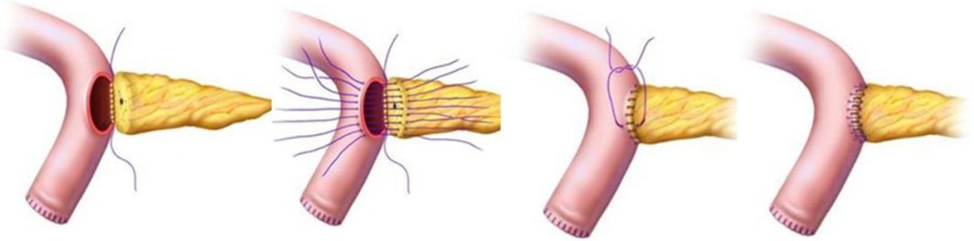 适用于不同大小的胰腺断端,无特殊应用限制条件胰腺空肠端侧吻合:(4)