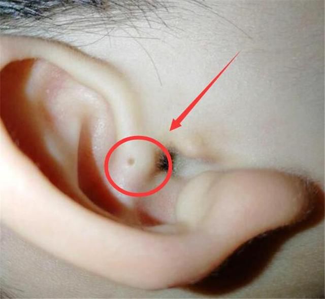 其实这个小洞并不是幸运的象征,而是一种 先天畸形,学名叫 耳前瘘管.