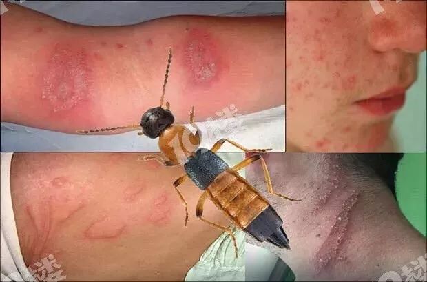 隐翅虫并不叮咬人 ,但是其体内的 强酸性毒液 一旦沾到皮肤上,有腐蚀