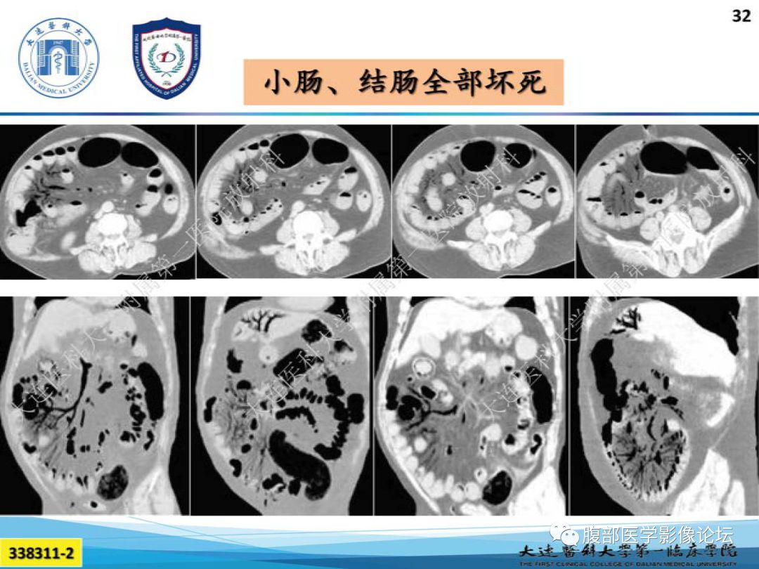 大咖讲座 | 刘爱连教授 小肠缺血性疾病的ct诊断(课件