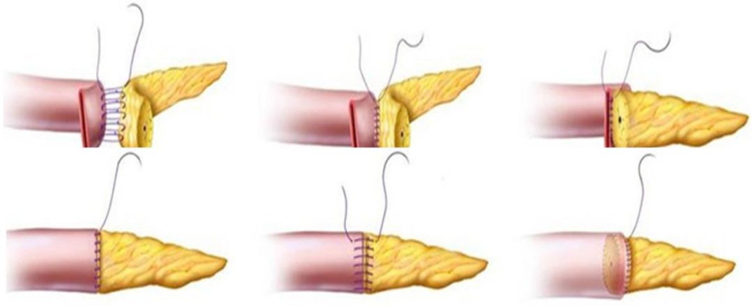 优点在于主胰管及胰腺残端全部吻合入空肠,操作相对简单;缺点是当