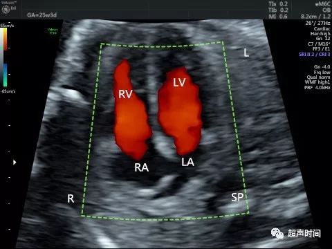 胎儿下腔静脉缺如:看懂这个病例就学会了诊断