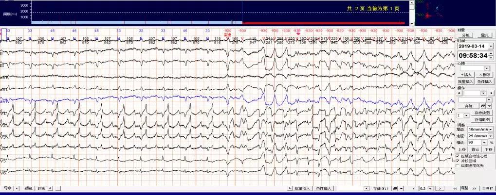 【每周一讲】罕见案例: "同源性心室分离"实时心电图一例