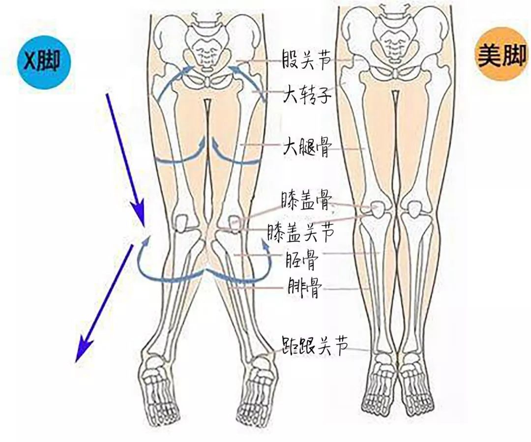 膝盖合不拢,90%都属于o型腿.