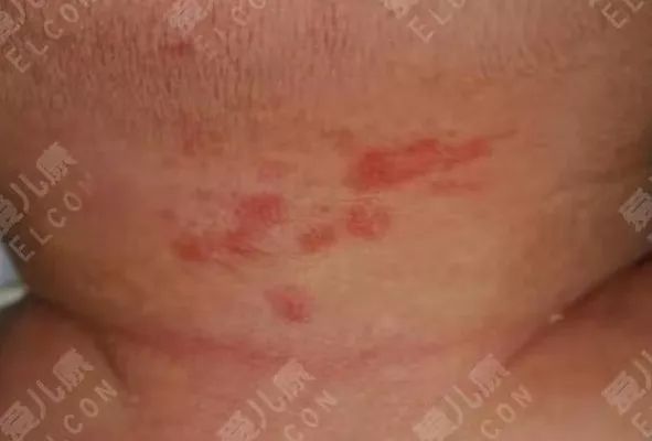                     宝宝脖子上起了红斑，可能是斑状血管瘤......