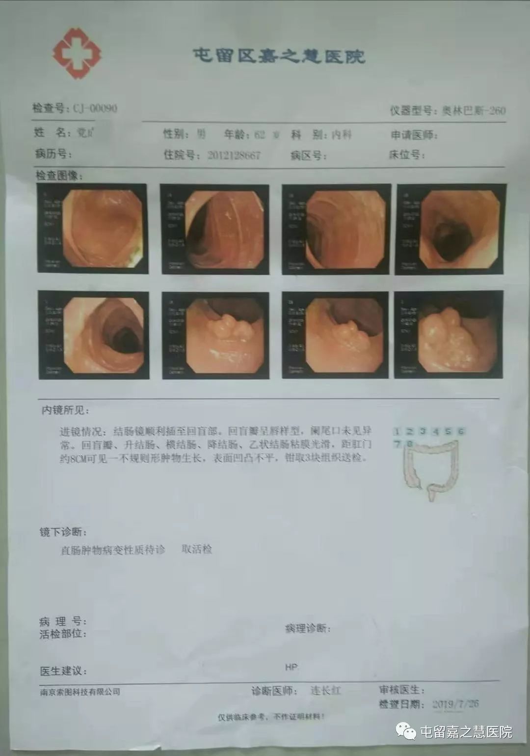 屯留区首例esd内镜黏膜下剥离术消化道早癌的首选治疗