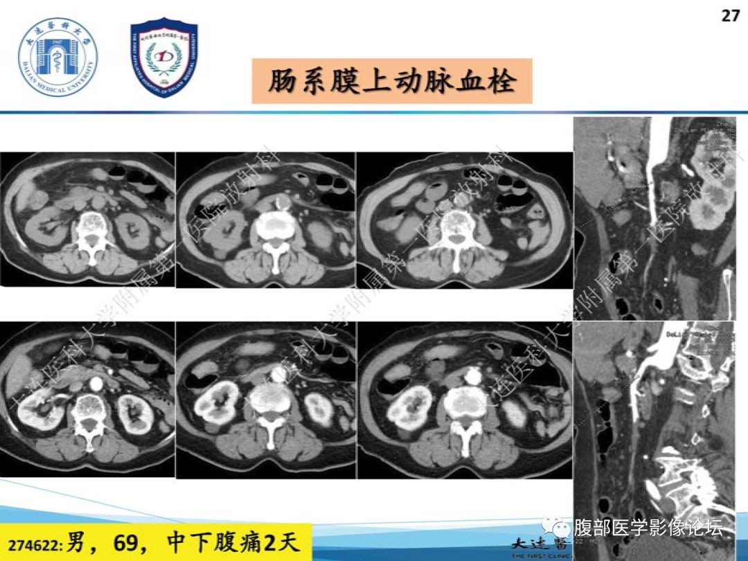 大咖讲座 | 刘爱连教授 小肠缺血性疾病的ct诊断(课件