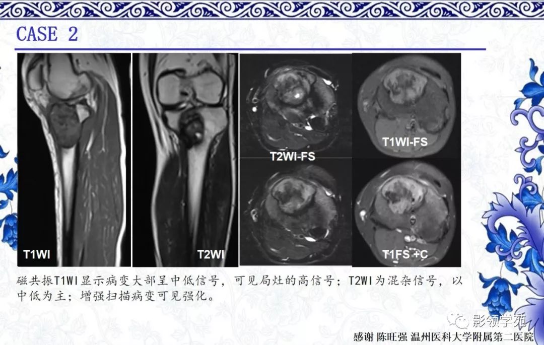 【经典】非骨化性纤维瘤/良性纤维组织细胞瘤的影像表现及鉴别_皮质