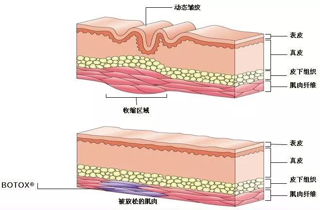 眼角长皱纹了怎么办啊