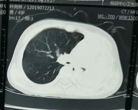 4岁男童咳嗽致左肺“消失” 孩子出现这些症状家长要注意了！